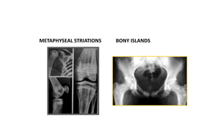 METAPHYSEAL STRIATIONS BONY ISLANDS
 