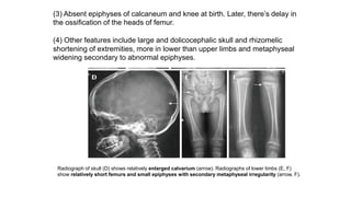 Radiograph of skull (D) shows relatively enlarged calvarium (arrow). Radiographs of lower limbs (E, F)
show relatively short femurs and small epiphyses with secondary metaphyseal irregularity (arrow, F).
(3) Absent epiphyses of calcaneum and knee at birth. Later, there’s delay in
the ossification of the heads of femur.
(4) Other features include large and dolicocephalic skull and rhizomelic
shortening of extremities, more in lower than upper limbs and metaphyseal
widening secondary to abnormal epiphyses.
 