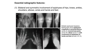 Essential radiographic features:
(1) Bilateral and symmetric involvement of epiphyses of hips, knees, ankles,
shoulders, elbows, wrists and hands and feet;
Multiple epiphyseal dysplasia.
Radiographs show epiphyseal
irregularity in proximal femurs
(arrow, A), around knee joints
(arrow, B), elbow (arrow, C) with
involvement of epiphyses of
hands and feet (arrows in D, E).
 