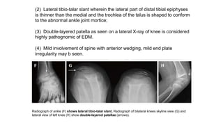 Radiograph of ankle (F) shows lateral tibio-talar slant. Radiograph of bilateral knees skyline view (G) and
lateral view of left knee (H) show double-layered patellae (arrows).
(2) Lateral tibio-talar slant wherein the lateral part of distal tibial epiphyses
is thinner than the medial and the trochlea of the talus is shaped to conform
to the abnormal ankle joint mortice;
(3) Double-layered patella as seen on a lateral X-ray of knee is considered
highly pathognomic of EDM.
(4) Mild involvement of spine with anterior wedging, mild end plate
irregularity may b seen.
 