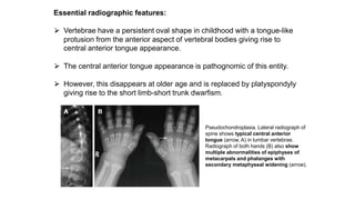 Essential radiographic features:
⮚ Vertebrae have a persistent oval shape in childhood with a tongue-like
protusion from the anterior aspect of vertebral bodies giving rise to
central anterior tongue appearance.
⮚ The central anterior tongue appearance is pathognomic of this entity.
⮚ However, this disappears at older age and is replaced by platyspondyly
giving rise to the short limb-short trunk dwarfism.
Pseudochondroplasia. Lateral radiograph of
spine shows typical central anterior
tongue (arrow, A) in lumbar vertebrae.
Radiograph of both hands (B) also show
multiple abnormalities of epiphyses of
metacarpals and phalanges with
secondary metaphyseal widening (arrow).
 