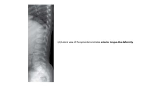 (A) Lateral view of the spine demonstrates anterior tongue-like deformity.
 