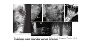Chondrodysplasia punctata. radiograph (A) shows coronal clefting (arrow). Radiographs of another patient
show stippling of vertebral bodies, in toes, tarsal bones and in carpals.
 