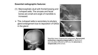Essential radiographic features:
(1) Macrocephalic skull with frontal bossing and
J-shaped sella. The sinuses and facial
bones are small and angle of mandible is
increased.
⮚ The J-shaped sella is secondary to pituitary
gland enlargement due to deposition of GAGs
in the gland;
Magnified views of lateral skull radiographs. Normal skull,
presenting a regularly shaped sella (a). Skull of a 2-
year-old patient affected by MPS (b); the abnormal J-
shaped sella (white arrow).
 