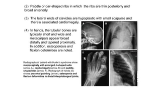 (2) Paddle or oar-shaped ribs in which the ribs are thin posteriorly and
broad anteriorly.
(3) The lateral ends of clavicles are hypoplastic with small scapulae and
there’s associated cardiomegaly.
(4) In hands, the tubular bones are
typically short and wide and
metacarpals appear broad
distally and tapered proximally.
In addition, osteoporosis and
flexion deformities are noted.
Radiographs of patient with Hurler’s syndrome show
macrocephaly with enlarged J-shaped sella
(arrow, A), cardiomegaly (arrow, B) and paddle-
shaped ribs (arrow, F). Radiograph of hands (E)
shows proximal pointing (arrow), osteopenia and
flexion deformities in distal interphalangeal joints.
 
