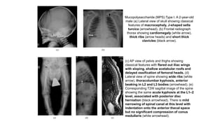 Mucopolysaccharide (MPS) Type I. A 2-year-old
male (a) Lateral view of skull showing classical
features of macrocephaly, J-shaped sella
turcica (arrowhead). (b) Frontal radiograph
thorax showing cardiomegaly (white arrow),
thick ribs (arrow heads) and short thick
clavicles (black arrow).
(c) AP view of pelvis and thighs showing
classical features with flared out iliac wings
with sloping, shallow acetabular roofs and
delayed ossification of femoral heads. (d)
Lateral view of spine showing wide ribs (white
arrow), thoracolumbar kyphosis, anterior
beaking in L2 and L3 bodies (arrowhead). (e)
Corresponding T2W sagittal image of the spine
showing the same acute kyphosis at the L1–2
level, associated with posterior disc
herniation (black arrowhead). There is mild
narrowing of spinal canal at this level with
indentation onto the anterior thecal space
but no significant compression of conus
medullaris (white arrowhead).
 