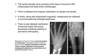 ⮚ The hands typically show pointing of the base of second to fifth
metacarpals and distal ends of phalanges.
⮚ There is delayed and irregular ossification of carpals and tarsals.
⮚ In limbs, along with epiphyseal irregularity, metaphyses are widened
to accommodate the enlarged epiphyses.
⮚ There is also delayed ossification
of femoral heads with poorly
developed acetabula leading to
premature arthropathy.
Radiograph of hand (C) shows proximal pointing
of metacarpals. Radiograph of pelvis and lower
limbs (D) show delayed ossification of femoral
heads, irregular epiphyses and secondary
metaphyseal widening in proximal femur and
around knee joint (arrows).
 