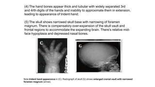 (4) The hand bones appear thick and tubular with widely separated 3rd
and 4rth digits of the hands and inability to approximate them in extension,
leading to appearance of trident hand;
(5) The skull shows narrowed skull base with narrowing of foramen
magnum. There is compensatory over-expansion of the skull vault and
frontal regions to accommodate the expanding brain. There’s relative mid-
face hypoplasia and depressed nasal bones.
Note trident hand appearance in (C). Radiograph of skull (G) shows enlarged cranial vault with narrowed
foramen magnum (arrow).
 