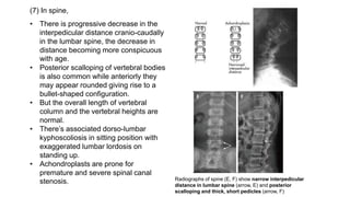 (7) In spine,
• There is progressive decrease in the
interpedicular distance cranio-caudally
in the lumbar spine, the decrease in
distance becoming more conspicuous
with age.
• Posterior scalloping of vertebral bodies
is also common while anteriorly they
may appear rounded giving rise to a
bullet-shaped configuration.
• But the overall length of vertebral
column and the vertebral heights are
normal.
• There’s associated dorso-lumbar
kyphoscoliosis in sitting position with
exaggerated lumbar lordosis on
standing up.
• Achondroplasts are prone for
premature and severe spinal canal
stenosis. Radiographs of spine (E, F) show narrow interpedicular
distance in lumbar spine (arrow, E) and posterior
scalloping and thick, short pedicles (arrow, F)
 