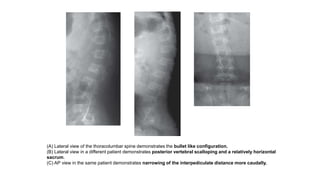 (A) Lateral view of the thoracolumbar spine demonstrates the bullet like configuration.
(B) Lateral view in a different patient demonstrates posterior vertebral scalloping and a relatively horizontal
sacrum.
(C) AP view in the same patient demonstrates narrowing of the interpediculate distance more caudally.
 