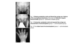 Fig. 11 Sloping acetabular roofs and flared iliac wings are a feature
of the mucopolysaccharidoses. Note also the flattened irregular
femoral heads (group 22 – dysostosis multiplex group)
Fig. 12 Horizontal, acetabular roofs and squared iliac wings are
characteristic of achondroplasia (group 1 – achondroplasia group)
Fig. 13 The trident hand of achondroplasia (group 1 – achondroplasia
group)
 