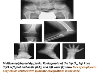 Multiple epiphyseal dysplasia. Radiographs of the hip (A), left knee
(B,C), left foot and ankle (D,E), and left wrist (F) show lack of epiphyseal
ossification centers with punctate calcifications in the knee.
 