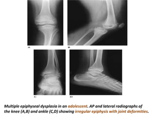Multiple epiphyseal dysplasia in an adolescent. AP and lateral radiographs of
the knee (A,B) and ankle (C,D) showing irregular epiphysis with joint deformities.
 