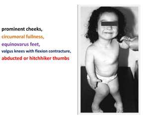 prominent cheeks,
circumoral fullness,
equinovarus feet,
valgus knees with flexion contracture,
abducted or hitchhiker thumbs
 