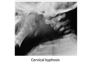 Cervical kyphosis
 
