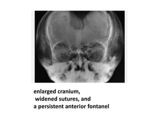 enlarged cranium,
widened sutures, and
a persistent anterior fontanel
 