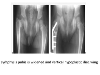 symphysis pubis is widened and vertical hypoplastic iliac wing
 
