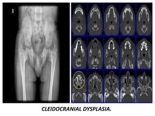 CLEIDOCRANIAL DYSPLASIA.
 