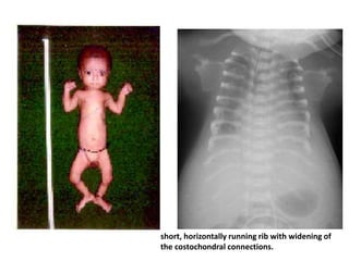 short, horizontally running rib with widening of
the costochondral connections.
 