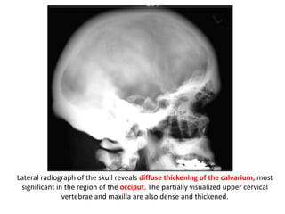 Lateral radiograph of the skull reveals diffuse thickening of the calvarium, most
significant in the region of the occiput. The partially visualized upper cervical
vertebrae and maxilla are also dense and thickened.
 