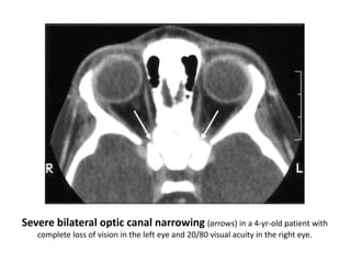 Severe bilateral optic canal narrowing (arrows) in a 4-yr-old patient with
complete loss of vision in the left eye and 20/80 visual acuity in the right eye.
 