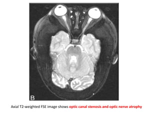 Axial T2-weighted FSE image shows optic canal stenosis and optic nerve atrophy
 