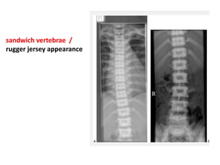 sandwich vertebrae /
rugger jersey appearance
 