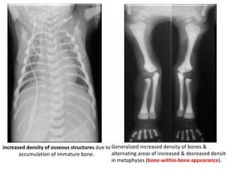 increased density of osseous structures due to
accumulation of immature bone.
Generalized increased density of bones &
alternating areas of increased & decreased density
in metaphyses (bone-within-bone appearance).
 