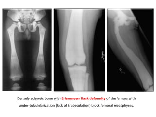 Densely sclerotic bone with Erlenmeyer flask deformity of the femurs with
under-tubulularization (lack of trabeculation) block femoral meatphyses.
 