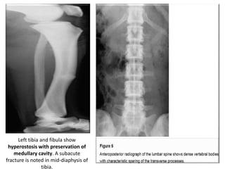 Left tibia and fibula show
hyperostosis with preservation of
medullary cavity. A subacute
fracture is noted in mid-diaphysis of
tibia.
 