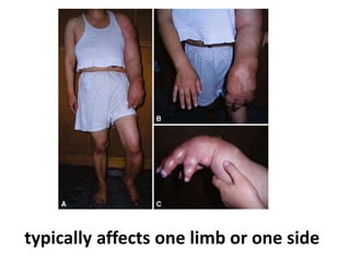 typically affects one limb or one side
 