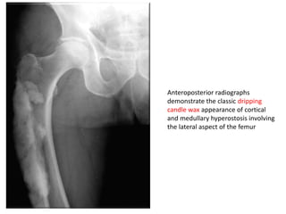 Anteroposterior radiographs
demonstrate the classic dripping
candle wax appearance of cortical
and medullary hyperostosis involving
the lateral aspect of the femur
 
