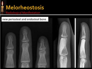 new periosteal and endosteal bone
 