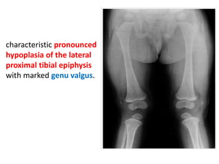 characteristic pronounced
hypoplasia of the lateral
proximal tibial epiphysis
with marked genu valgus.
 