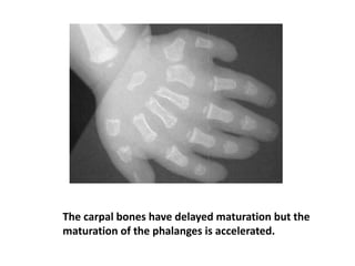 The carpal bones have delayed maturation but the
maturation of the phalanges is accelerated.
 