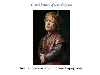 frontal bossing and midface hypoplasia
 