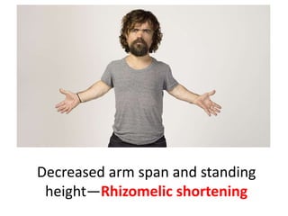 Decreased arm span and standing
height—Rhizomelic shortening
 