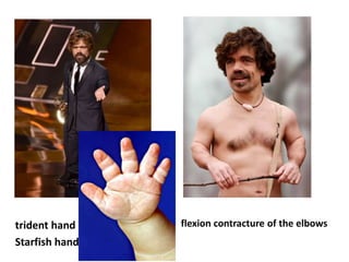 trident hand
Starfish hand
flexion contracture of the elbows
 