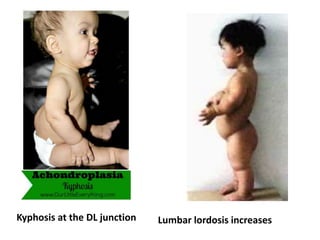Kyphosis at the DL junction Lumbar lordosis increases
 
