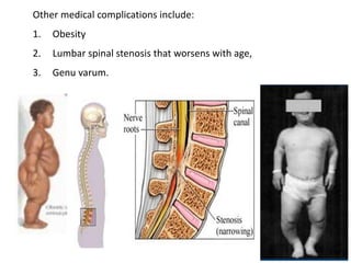 Other medical complications include:
1. Obesity
2. Lumbar spinal stenosis that worsens with age,
3. Genu varum.
 