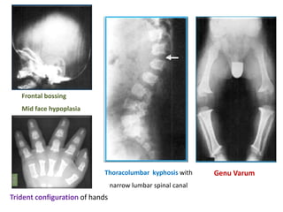 Frontal bossing
Mid face hypoplasia
Thoracolumbar kyphosis with
narrow lumbar spinal canal
Trident configuration of hands
Genu Varum
 