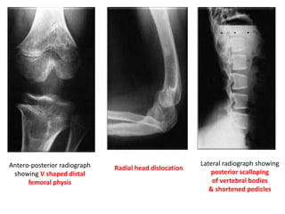 Antero-posterior radiograph
showing V shaped distal
femoral physis
Radial head dislocation
Lateral radiograph showing
posterior scalloping
of vertebral bodies
& shortened pedicles
 