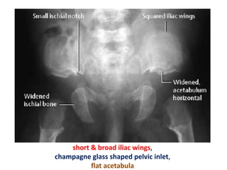 short & broad iliac wings,
champagne glass shaped pelvic inlet,
flat acetabula
 