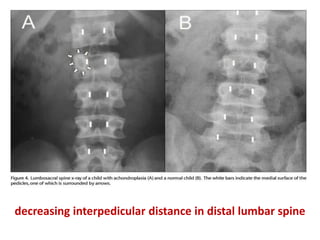decreasing interpedicular distance in distal lumbar spine
 