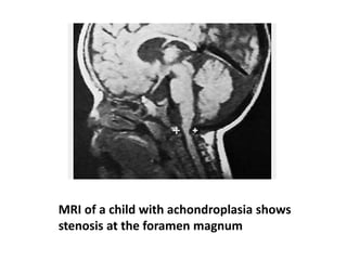 MRI of a child with achondroplasia shows
stenosis at the foramen magnum
 