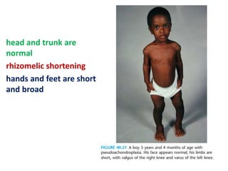 head and trunk are
normal
rhizomelic shortening
hands and feet are short
and broad
 