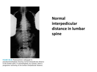Normal
interpedicular
distance in lumbar
spine
 