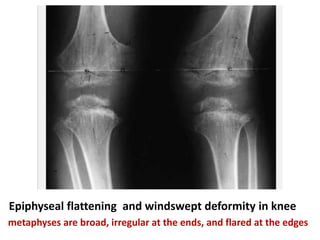 Epiphyseal flattening and windswept deformity in knee
metaphyses are broad, irregular at the ends, and flared at the edges
 