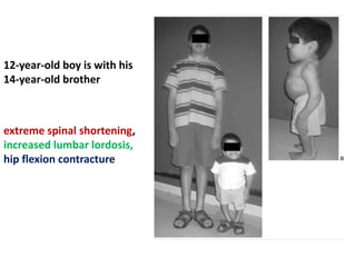 12-year-old boy is with his
14-year-old brother
extreme spinal shortening,
increased lumbar lordosis,
hip flexion contracture
 