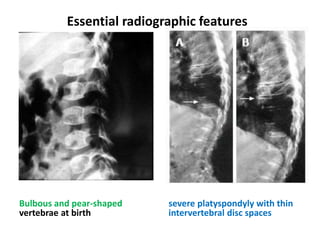 Bulbous and pear-shaped
vertebrae at birth
severe platyspondyly with thin
intervertebral disc spaces
Essential radiographic features
 